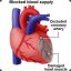 Myocardial.infarction