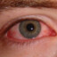 CONJUNCTIVITIS