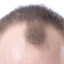 Receding Hairline