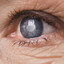 Glaucoma