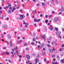 lymphohistiocytosis