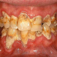 Rotten teeth