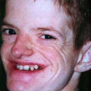 بيض مقشر متضخم