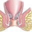 анальная трещина