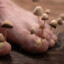 Foot Fungus