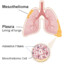 Mesothelioma Diagnoses