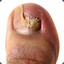 foot nail