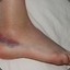 Bad Ankle