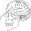 lobotomy