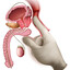 Exame de Prostata
