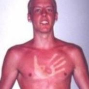 sunburn