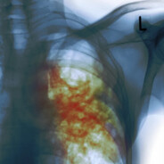 тубуркулез