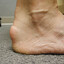 Haglund&#039;s Heel