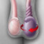 TorsiónTesticular