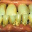 British teeth