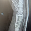 brokenwristnoflick
