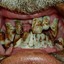 -Dry Caries