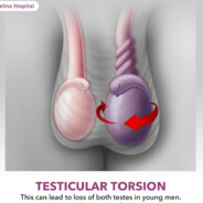 Testicular Torsion