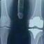 whenthekneesurgeryistomorrow