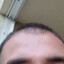 DÉFICE CAPILAR