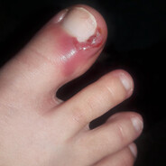 SwollenToeNail