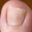 Toe nail