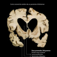 cerebro con alzheimer