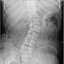 Escoliose