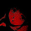 Sarcoma
