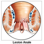 lesionanale