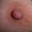 AN OVERGROWN NIPPLE