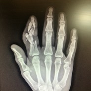 Finger Amputee
