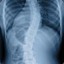 I Had Scoliosis