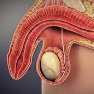 Erectile dysfunction
