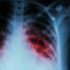 Tuberculosis