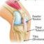 Osgood-Schlatter