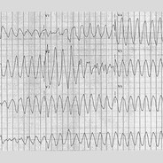 Torsades De Pointes