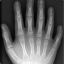 Polydactyly