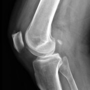 the_kneecap_stealer