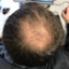 hairloss