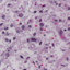 TOXOPLAZMOZ