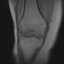 Full-Thickness Chondral Fissure