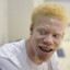 Негр альбинос