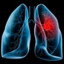 Lung cancer