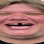 GL1MER