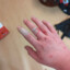 disfigured hand