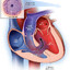 Eisenmenger Syndrome