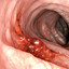 Colon Cancer avatar