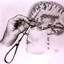 Lobotomy