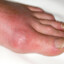 GOUT SURVIVOR